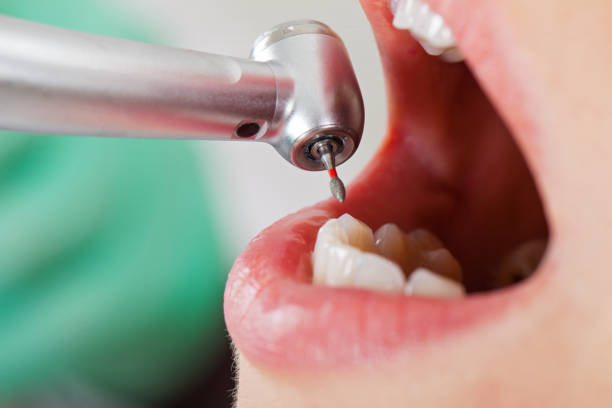 Urgent Tooth Repair in LA